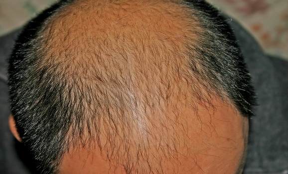 male-pattern-baldness.jpg