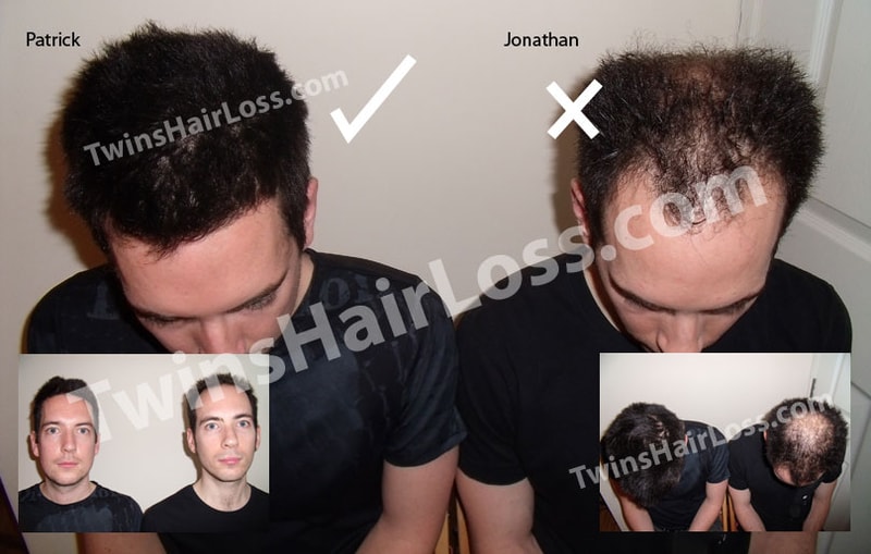 twins-hair-loss-main-photo.jpg