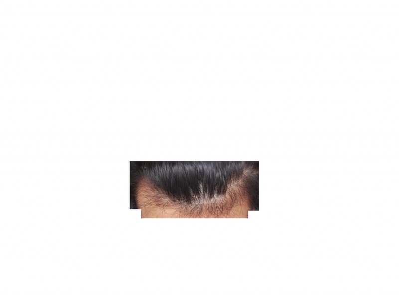 미녹시딜.jpg