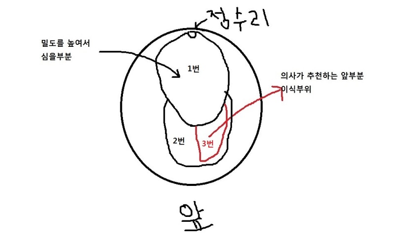 이식 범위.jpg