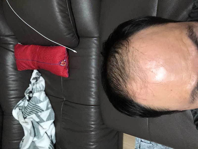 당일 이식 전 사진.jpeg