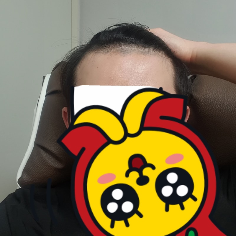 탈모.jpg
