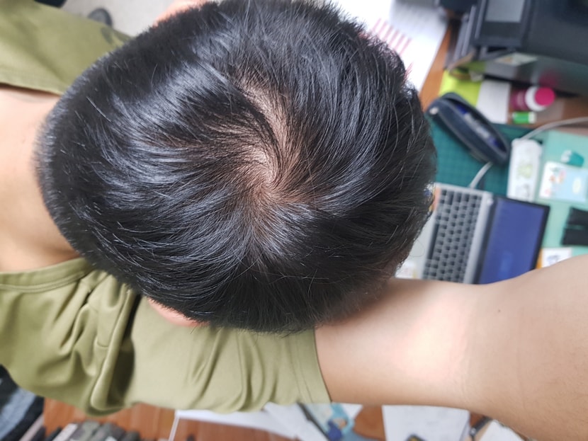 피나복용 12일차