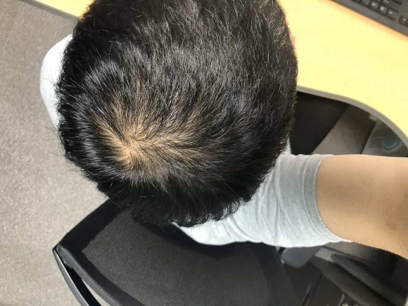 피나와 미녹을 시작
