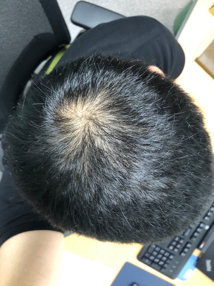 초기 탈모를 인지 (미녹과 영양제)