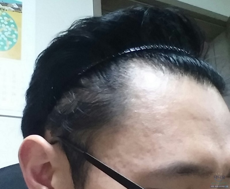 복용3개월1.jpg
