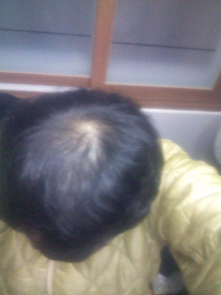 탈모.jpg
