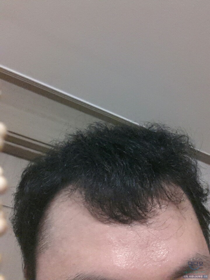 1년을 길러도 앞머리가 안자라는 예전사진