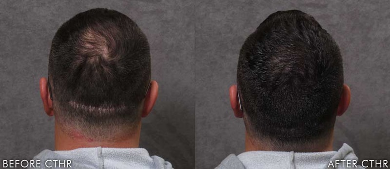 TonyScarBeforeAfter.jpg