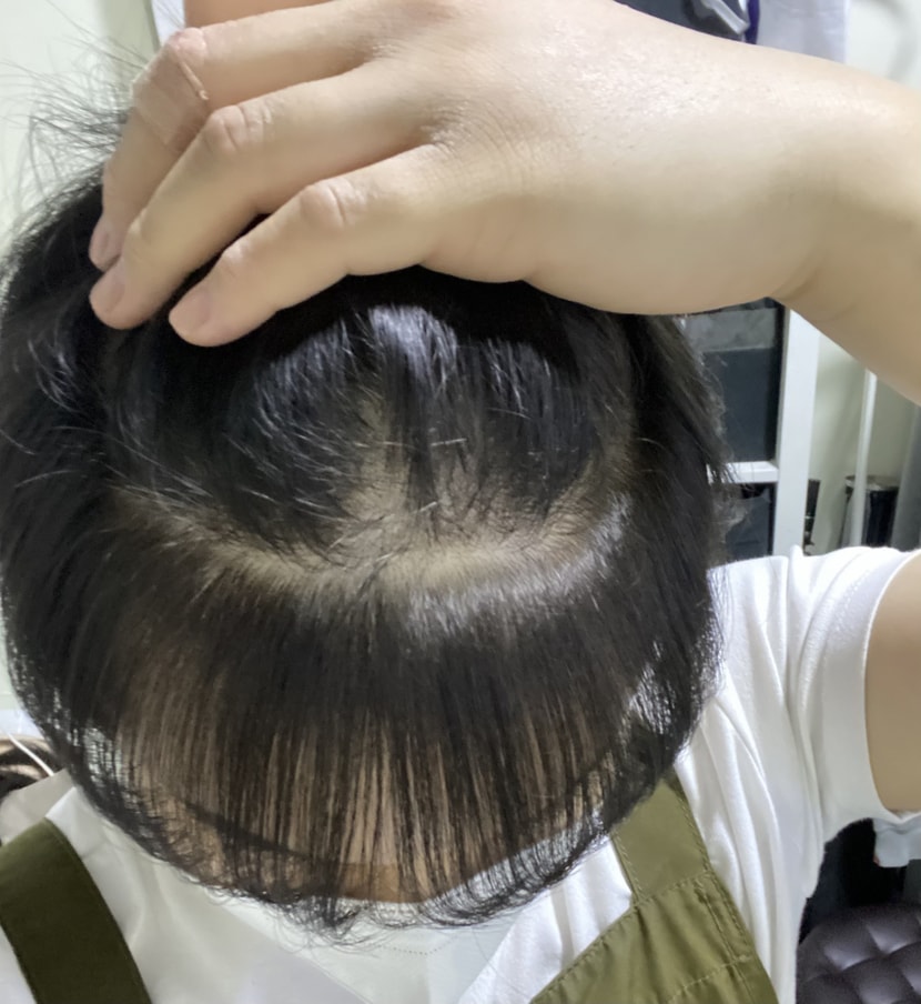 프로스카복용중