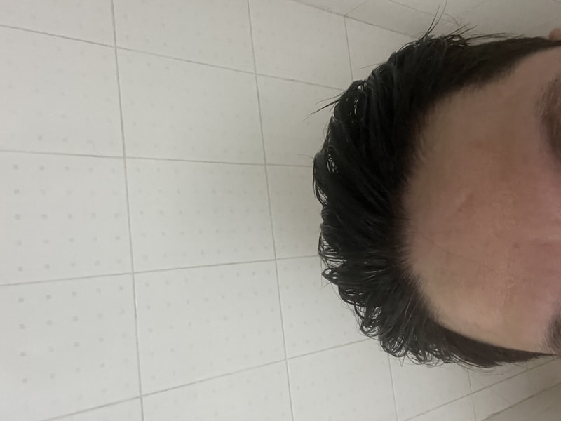 25살입니다 m자가 올라오네요..