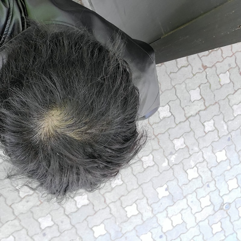안녕하세요 정수리 탈모 진행중일까요