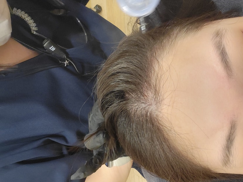 두피스케일링 시작