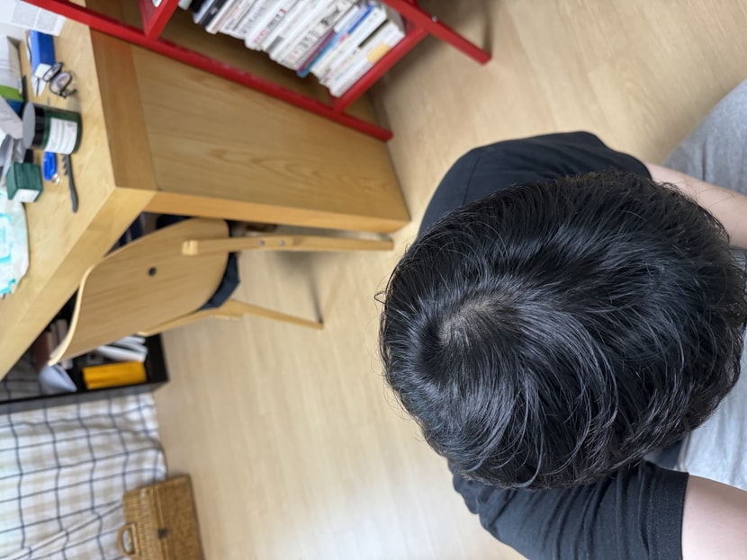 그리고 탈모가 진행중인거같긴한데 누가 위에서 제 머리를 볼까 두려운게 없지않아 있습니다 정수리 이식 상담 받아도 효과 없을거다 약을먹어라해서 약과 미녹시딜 영양제 먹고있습니다 정수리만 따로 수술 할때 효과 볼수 있을까요?ㅜㅜ