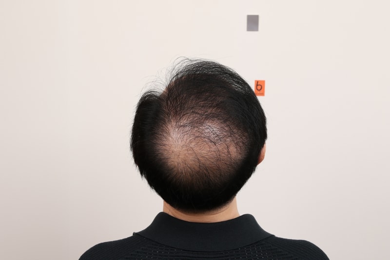 부산 탈모치료 리제네라액티바 맘모스 효과남깁니다. 대머리입니다..