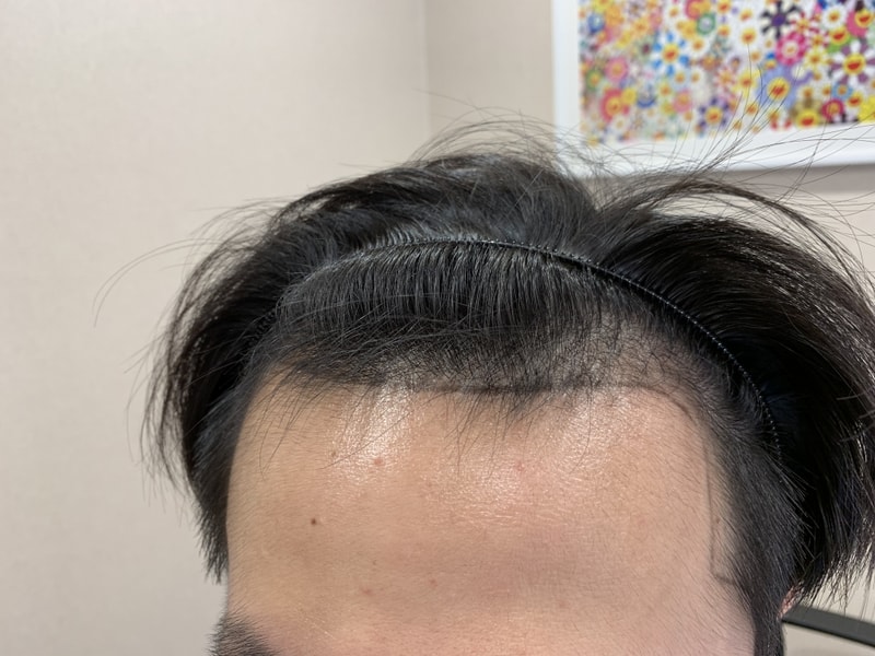 헤어라인1.jpg
