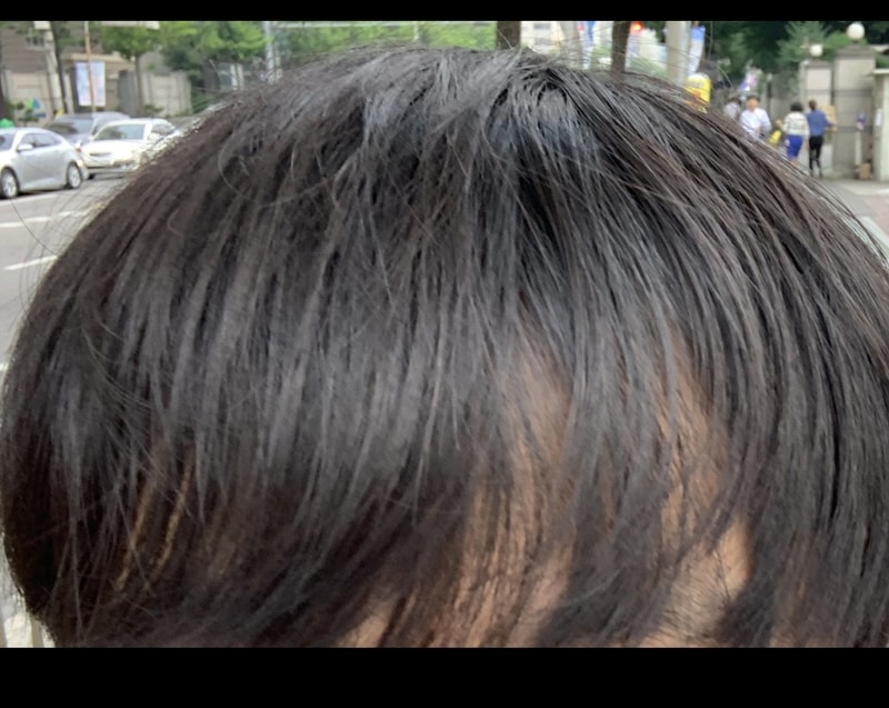 헤어라인3.jpg