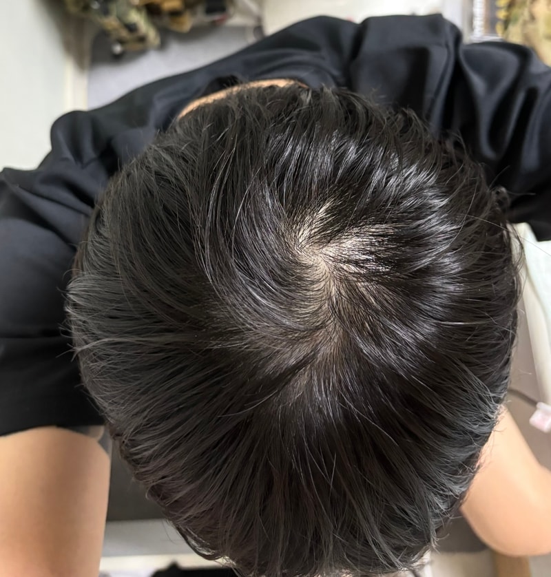 믾이 좋아진것같나요? 약 복용 7개월차