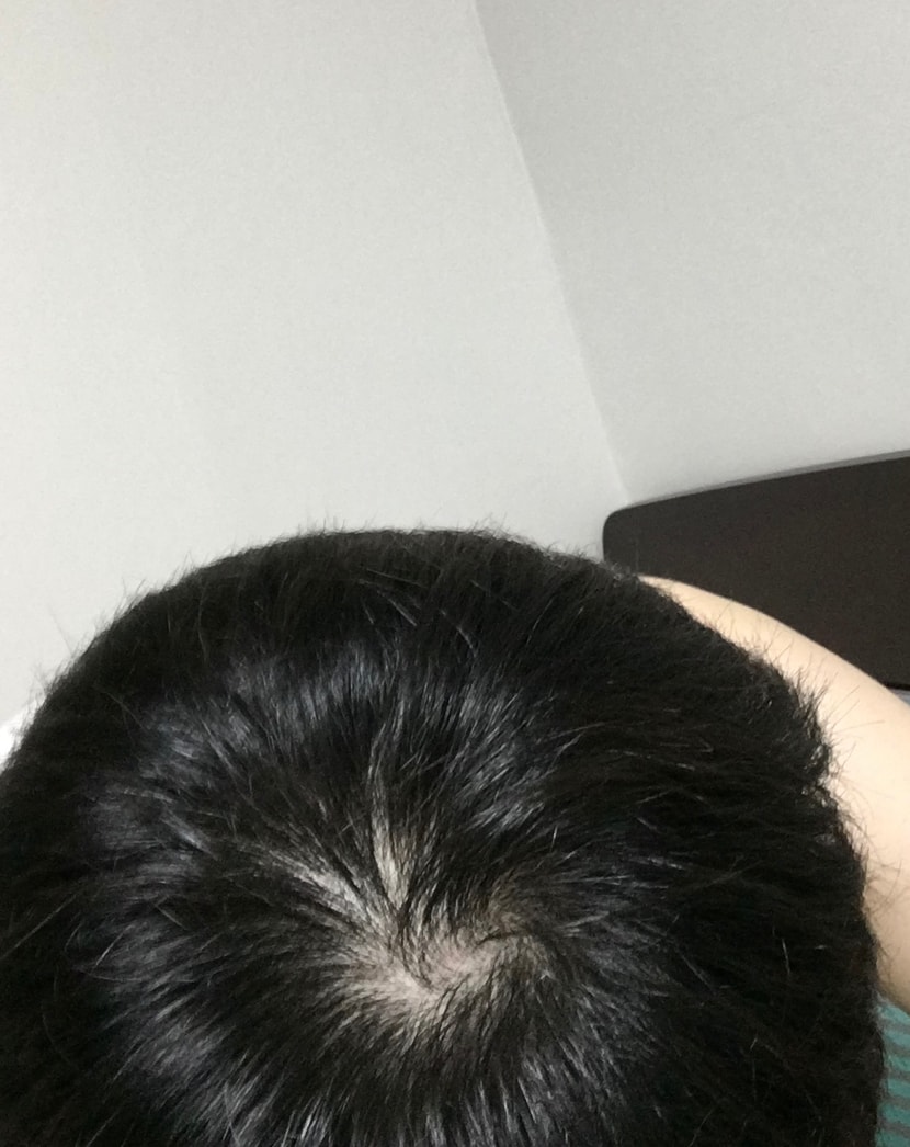 군 제대후 마음잡아 재수 중인데, 머리가 자꾸 빠지는거 같아서 닥터 포 헤어 샴푸 사서 감고 잘 말리면서 있었는데 오늘보니 경악이네요.... 