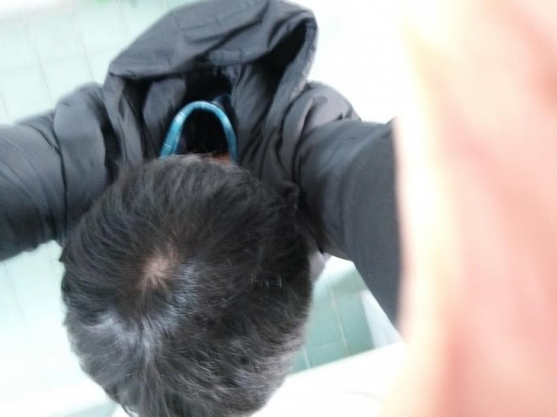 alopecia-20190121-155626-000-resize.jpg