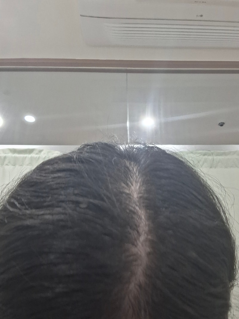 탈모수다