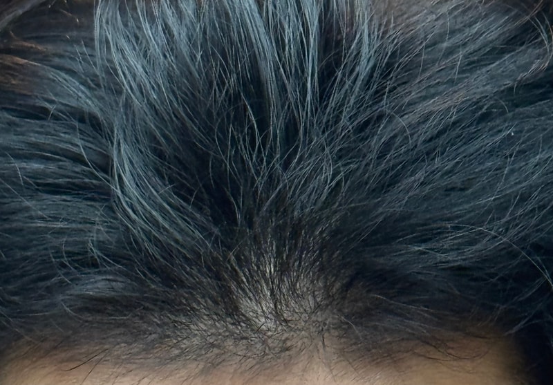 탈모수다