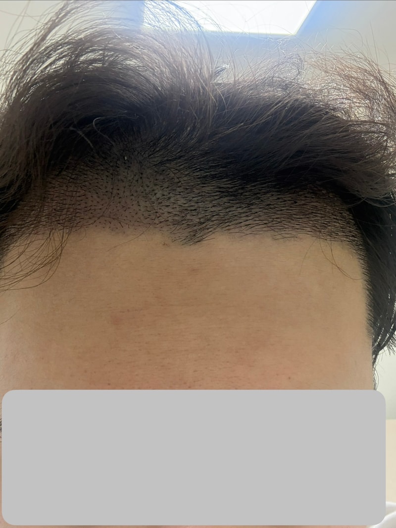 탈모수다