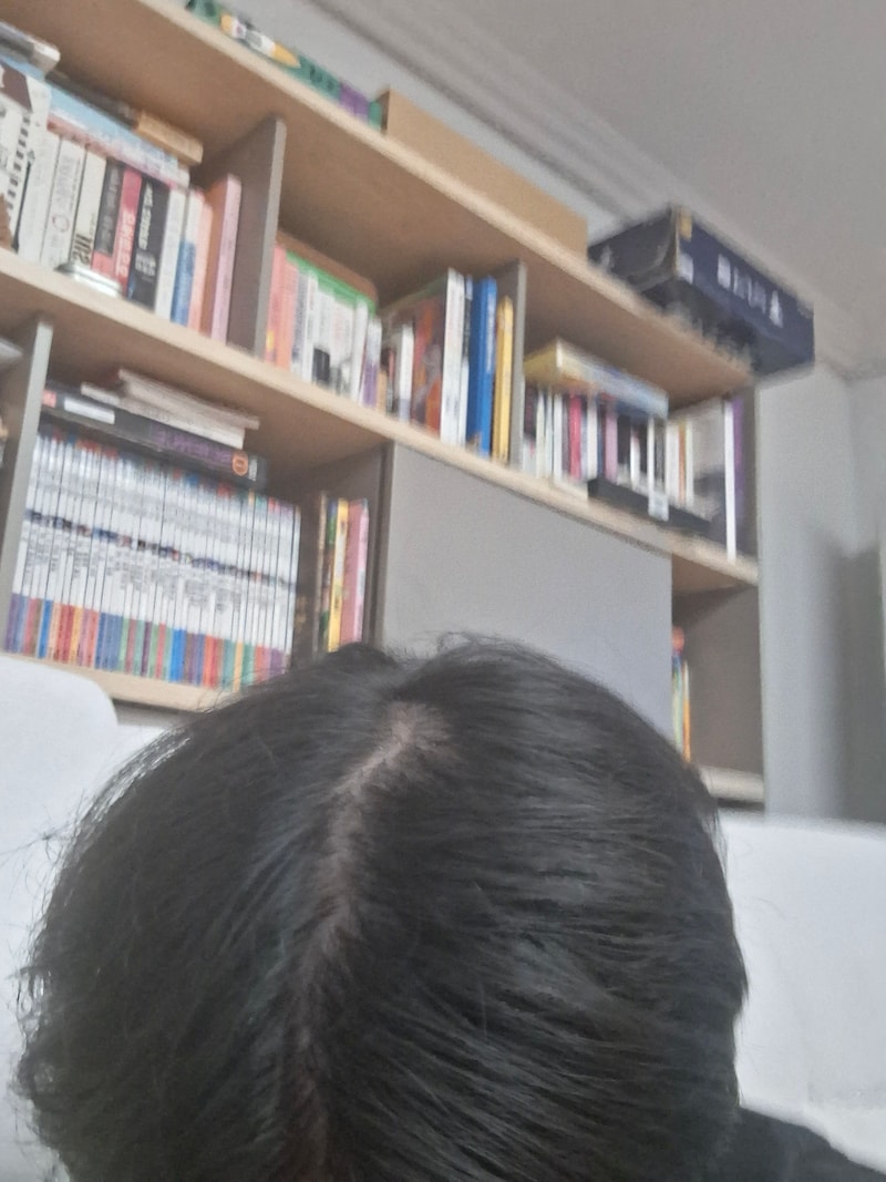 탈모수다