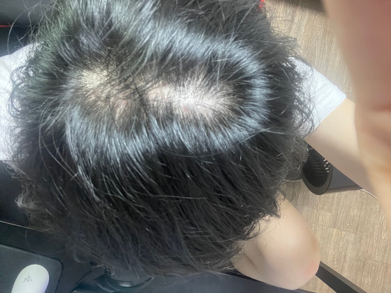 탈모인가요행님들.. 30대