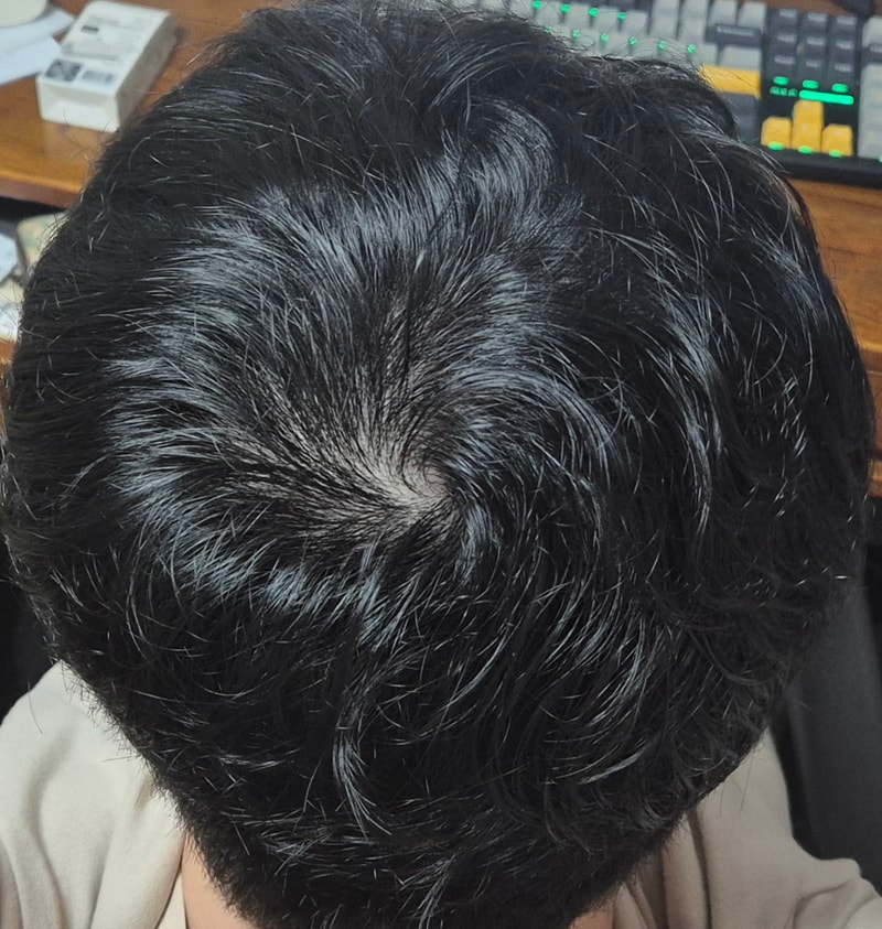 탈모 심해보이나요?