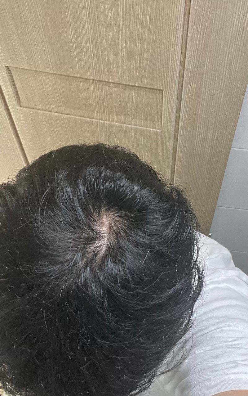 피나 복용 한달반 입니다 정수리 