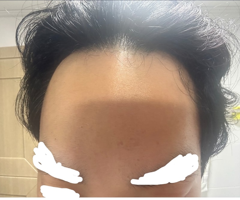 넓은 이마에 모발 이식 고민 중