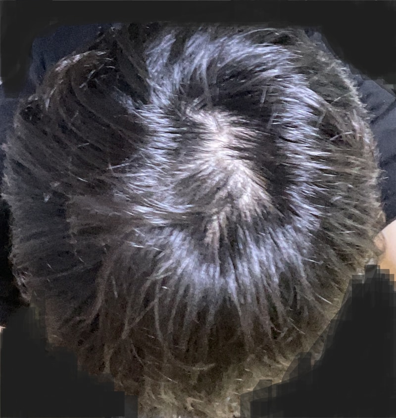 02년생 남자 탈모인가요?....