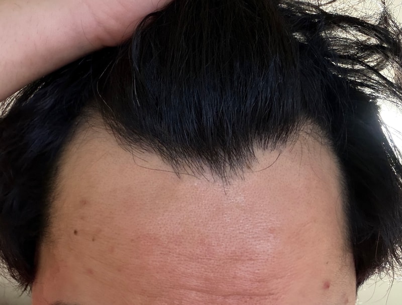 피나스테리드 약 8년 째 먹고 있는데 탈모 진행 되고 있는 것 같나요?