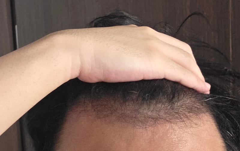 안녕하세요 형님들 탈모약 재복용을 앞두고 질문드립니다.. 