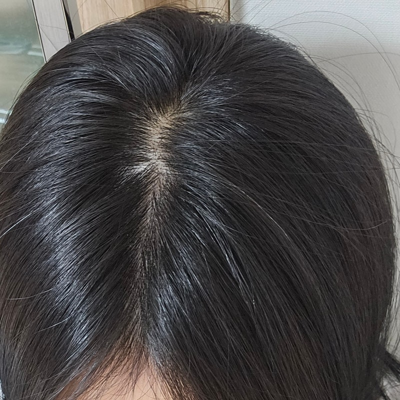30대 초반 여자 탈모 일까요...?