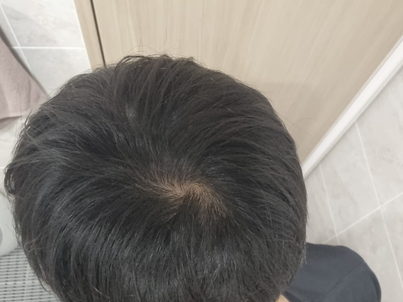정수리 탈모인가요?
