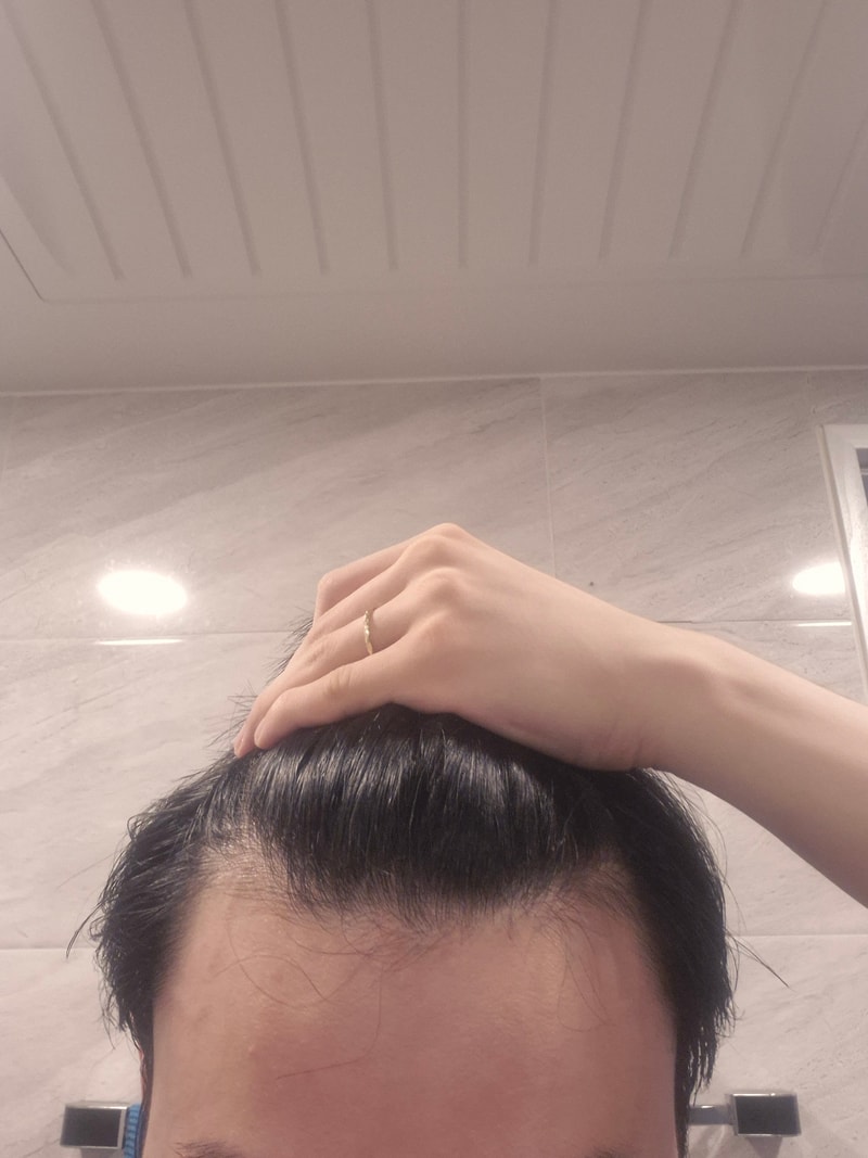 m자탈모일까요..?