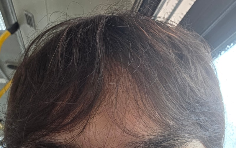 23살 앞머리탈모많이심한가요