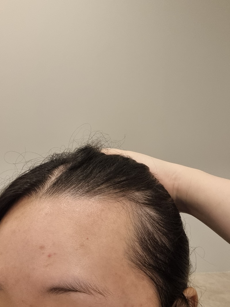 20代女性の薄毛