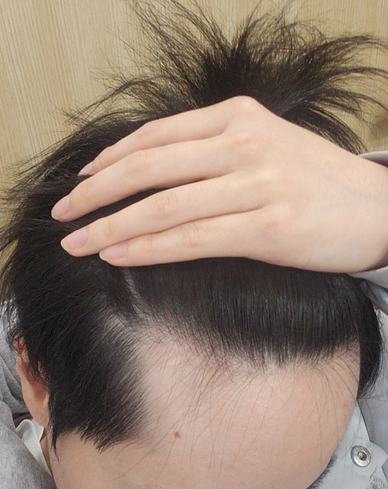 脱发对话