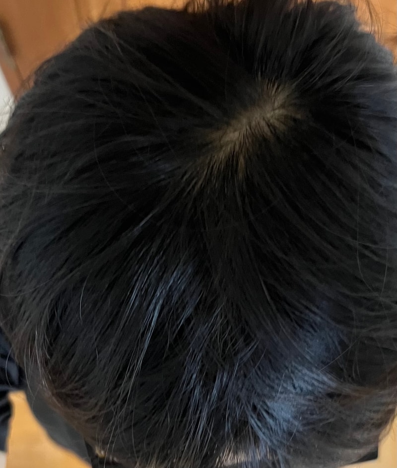 삼십대초반인데 혹시 탈모같아보이나요..?