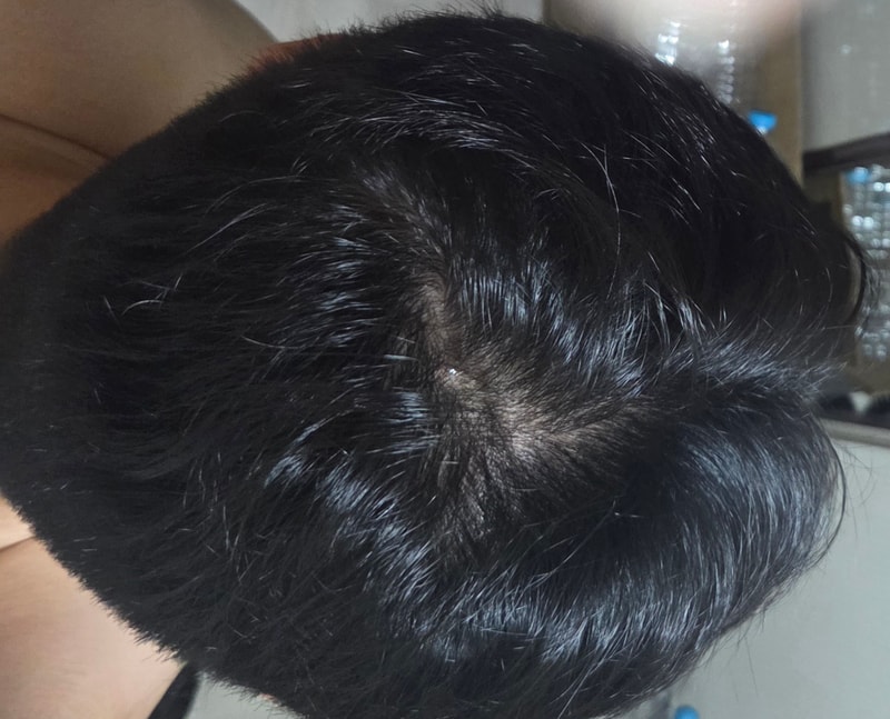 Has the top of the head hair started??