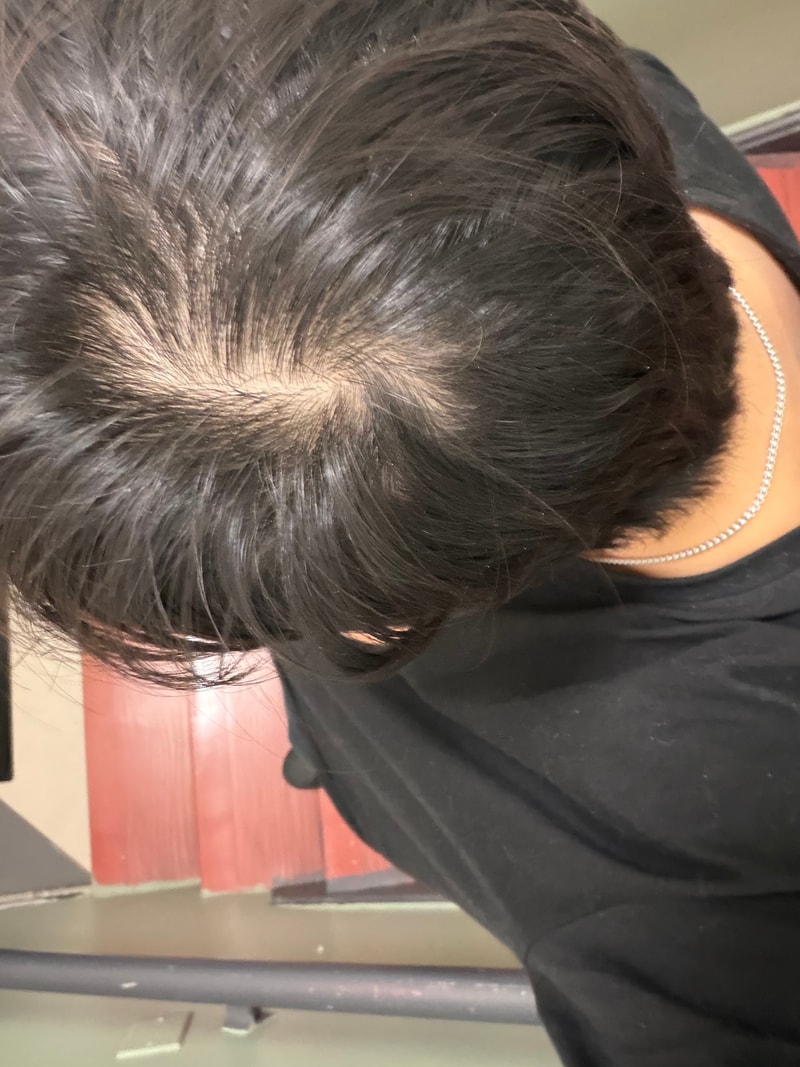 Is it hair loss.. I'm a man in his 20s
