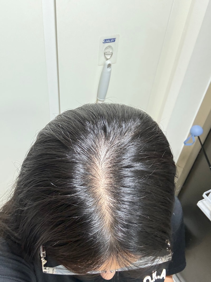 20대후반 여자 탈모겠죠…?