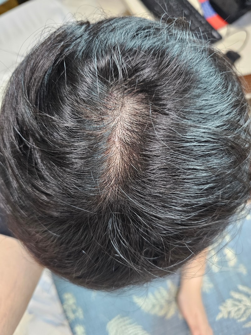 I feel like my scalp is depressed on the top of my head, but I don't know the reason
