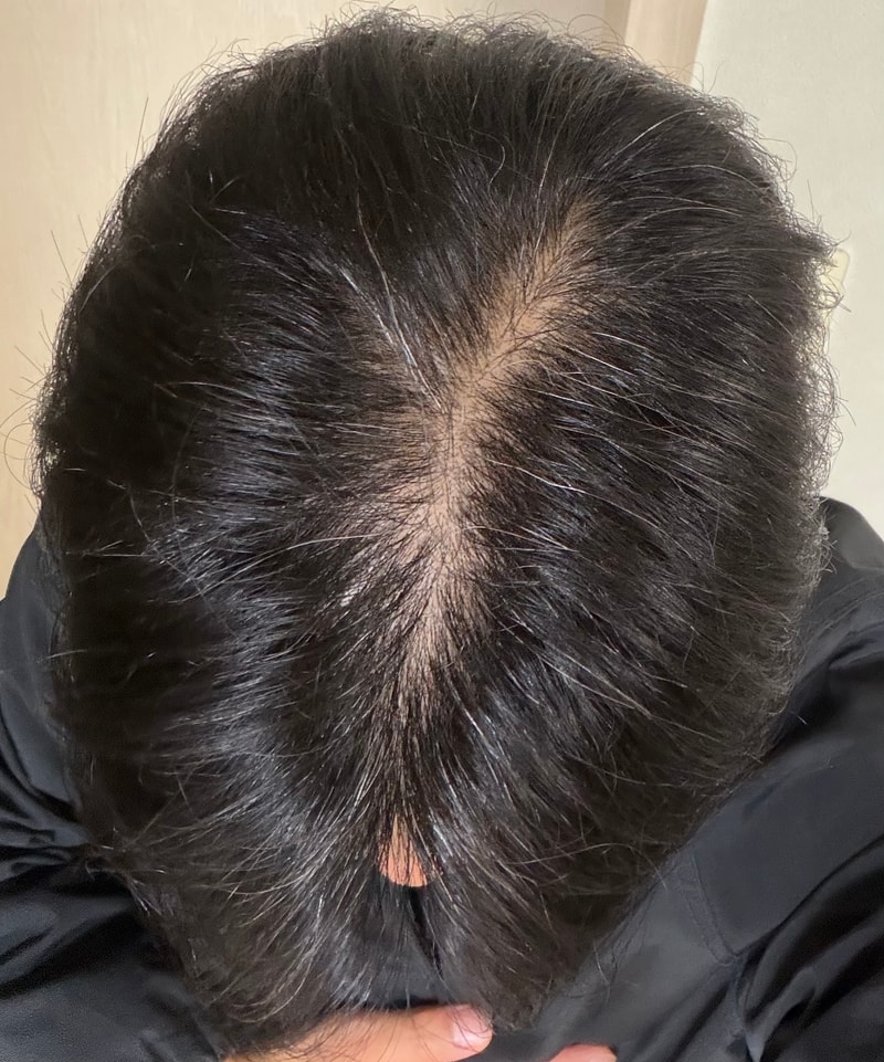 탈모가 맞겠죠... 후 믿고 싶지 않아요.