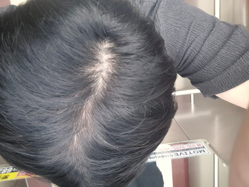 정수리 털리는거 진짜 짜증나네요