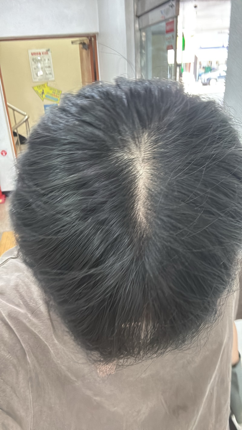 탈모인가요?