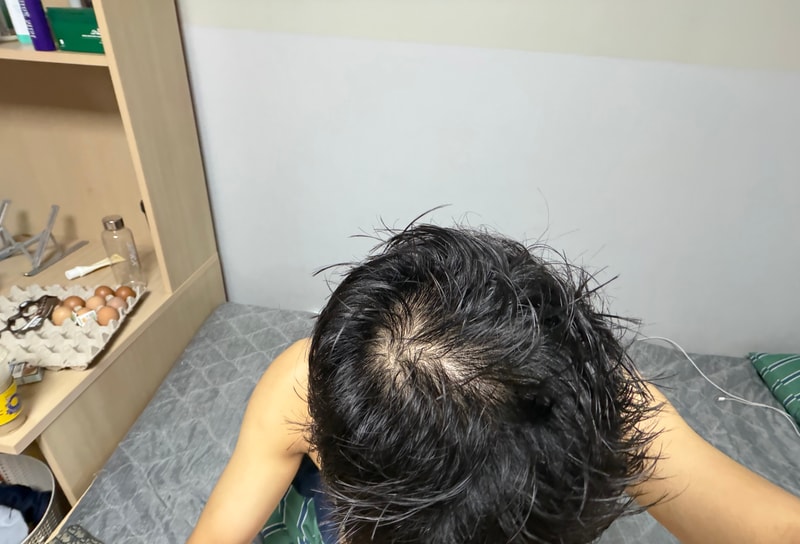22세 프로페시아 먹어도 무방한 머리겠죠?